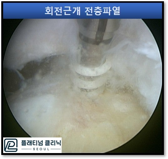 골수자극 재생술을 하고 봉합사를 삽입하는 관절경 사진