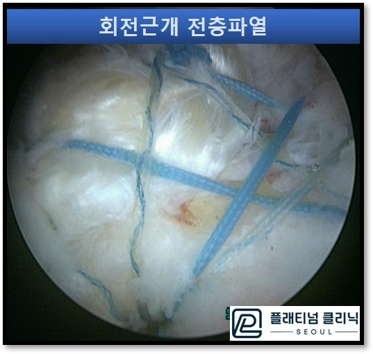 이중열봉합술과 충소봉합술을 시행한 관절경 사진