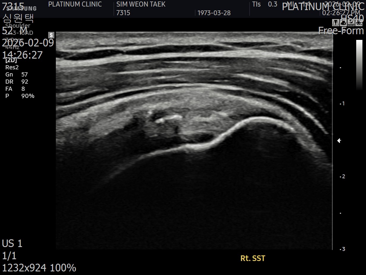 초음파에서 확인된 미세석회 영상