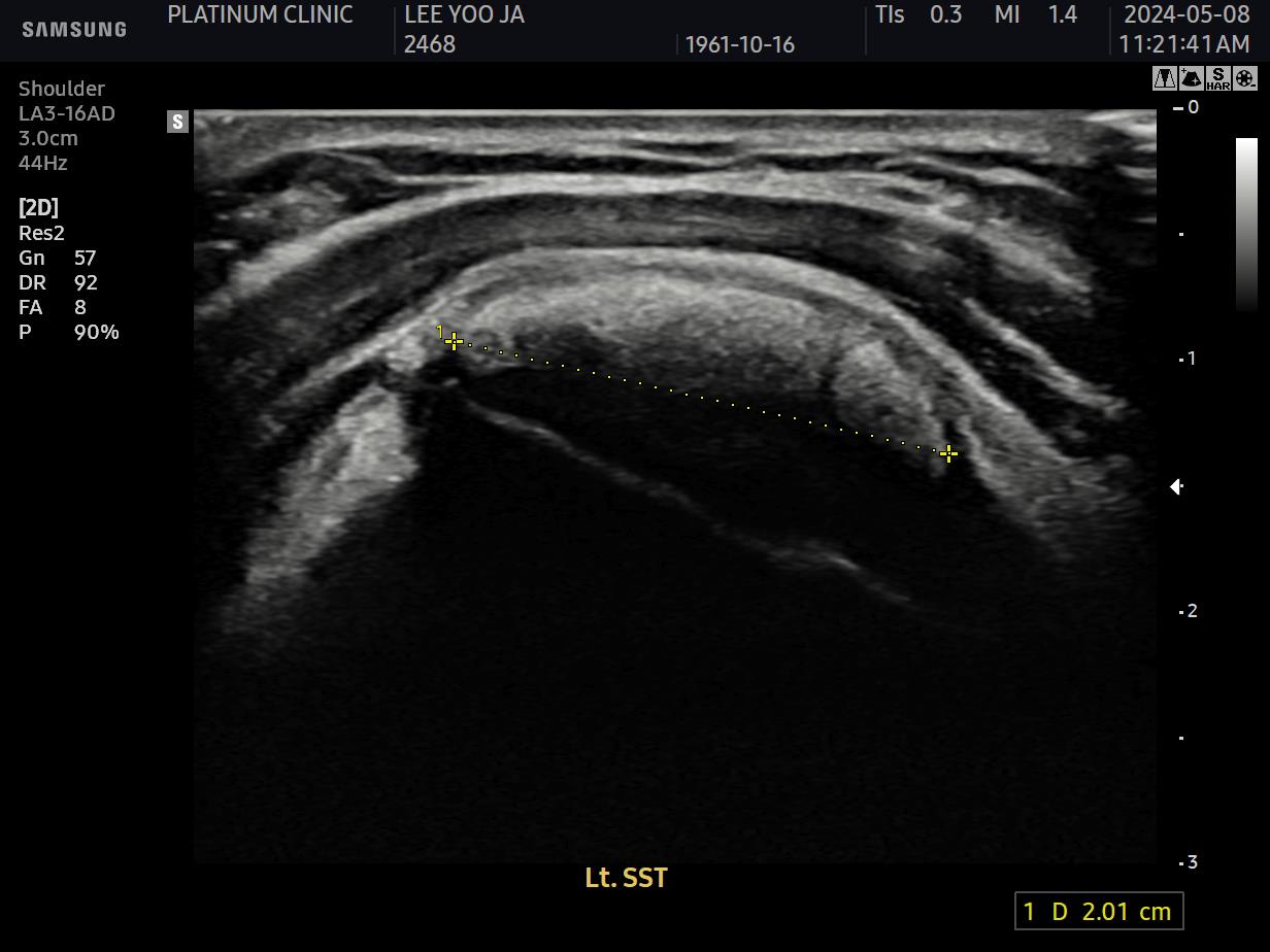 석회분쇄흡입술 시술 전 초음파 영상