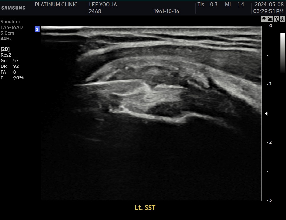 석회분쇄흡입술 시술 후 초음파 영상