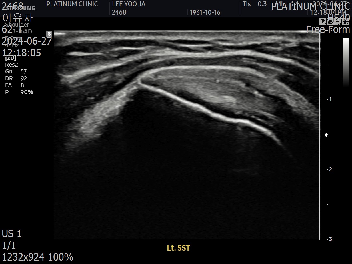 치료 6개월 후 경과 초음파 영상