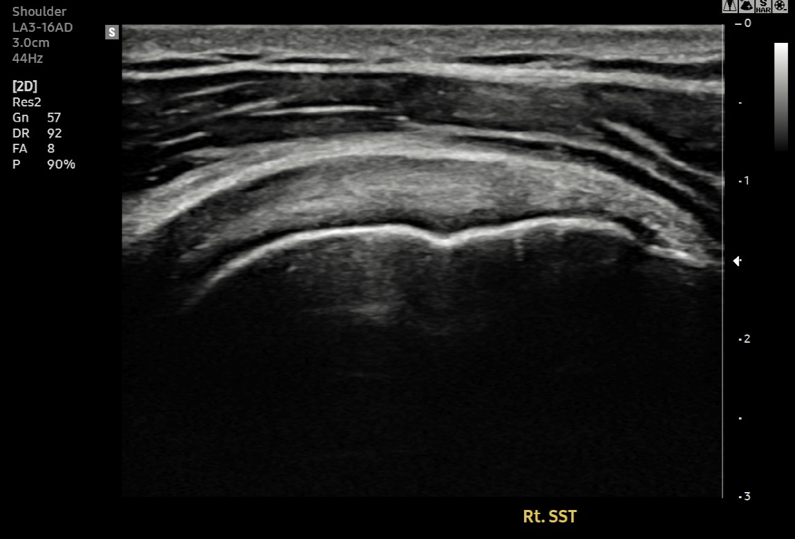 주사 치료 후 초음파 영상 — 파열 부위 재생 확인