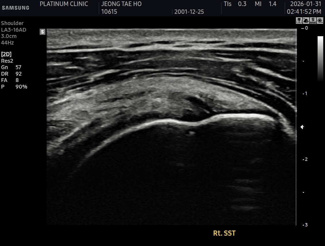 주사 치료 전 초음파 영상
