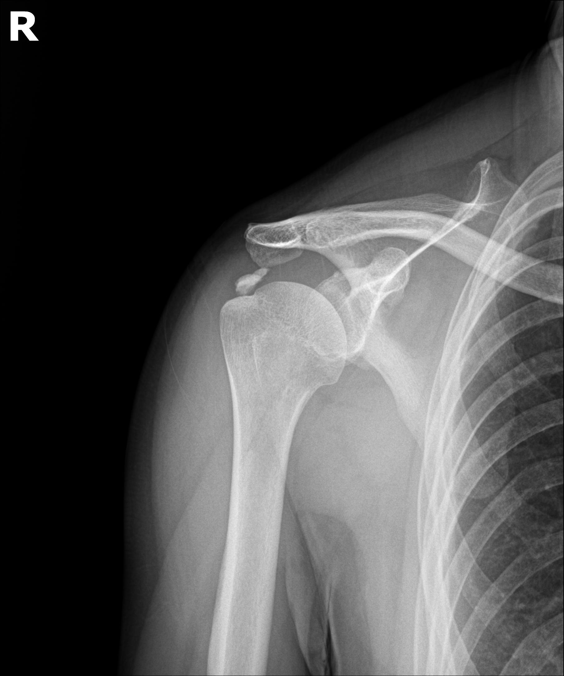 시술 전 X-ray: 1.5cm 형성기 석회