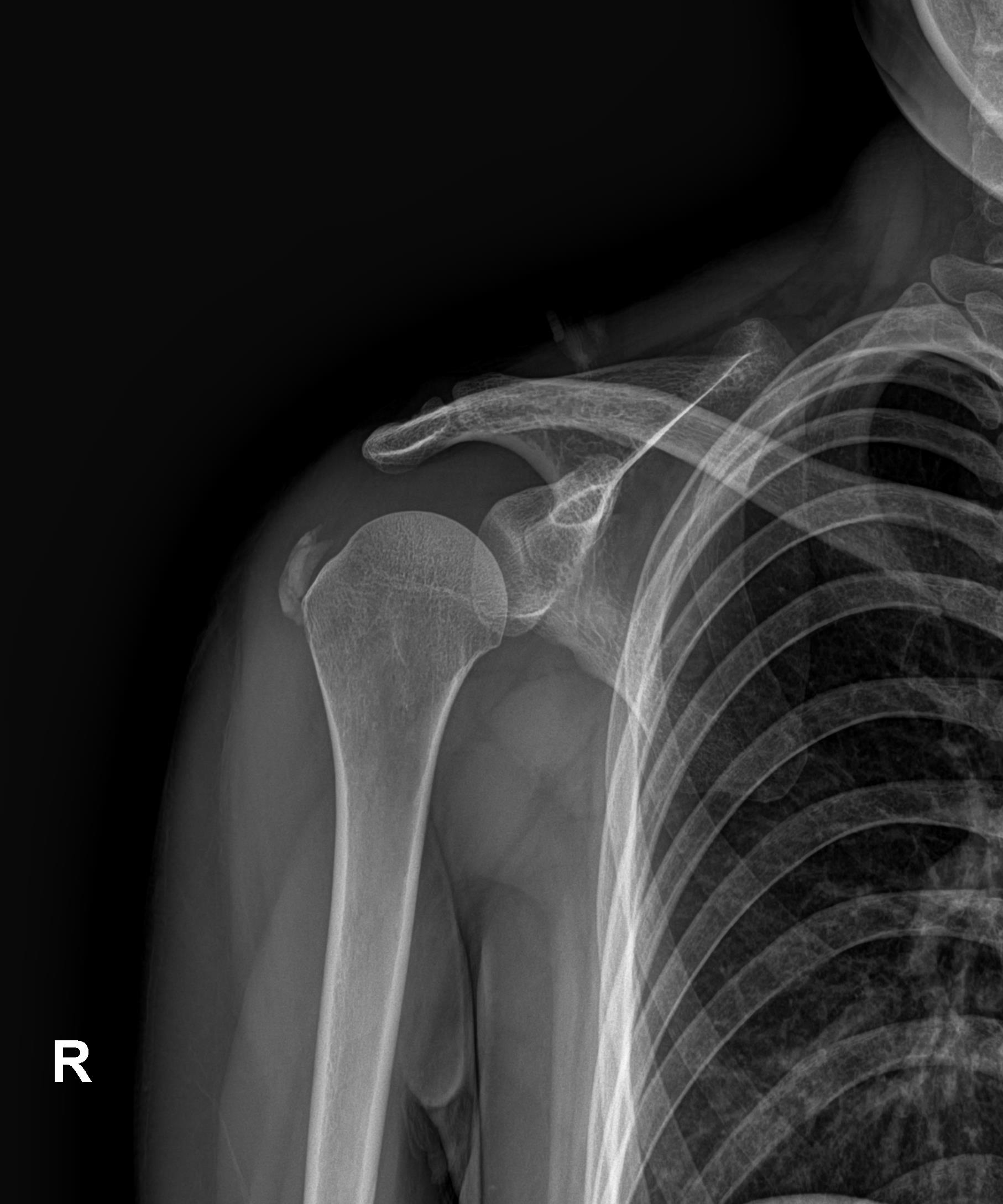 타 병원 3회 시술 후 X-ray