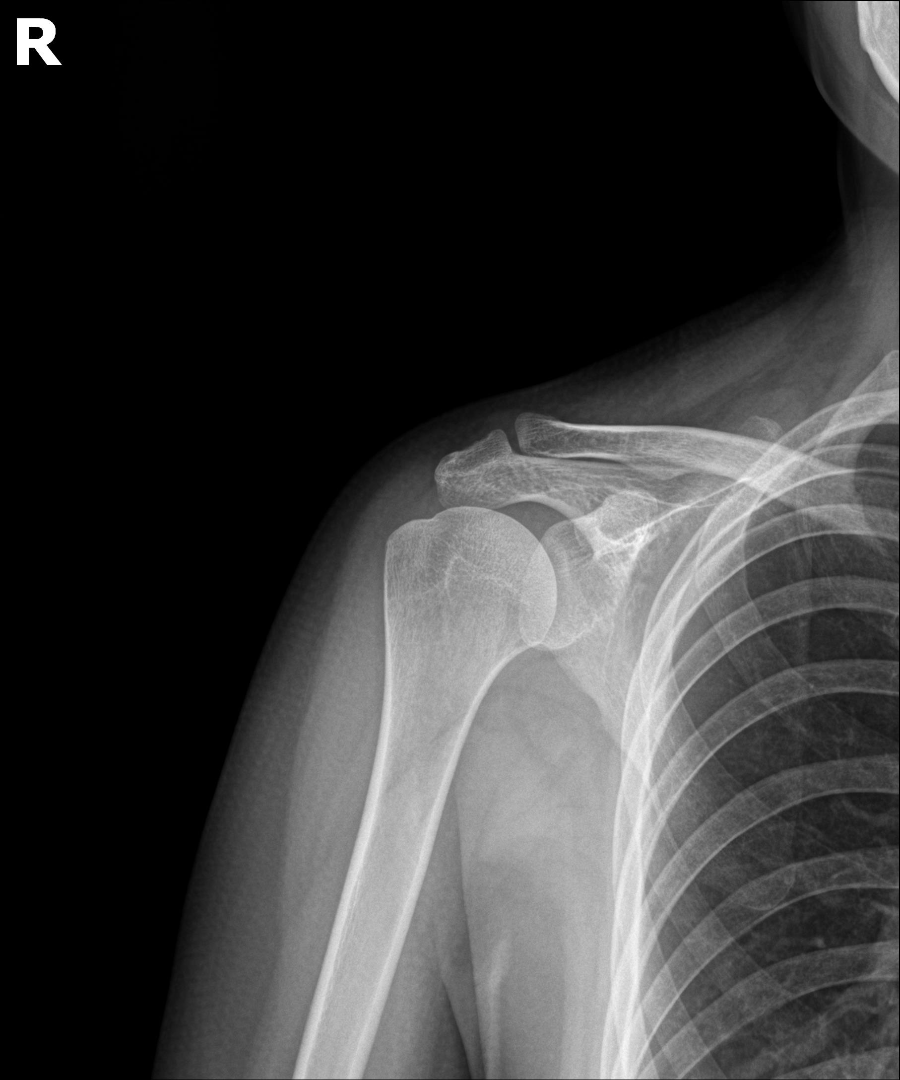 플래티넘 1회 시술 후 X-ray