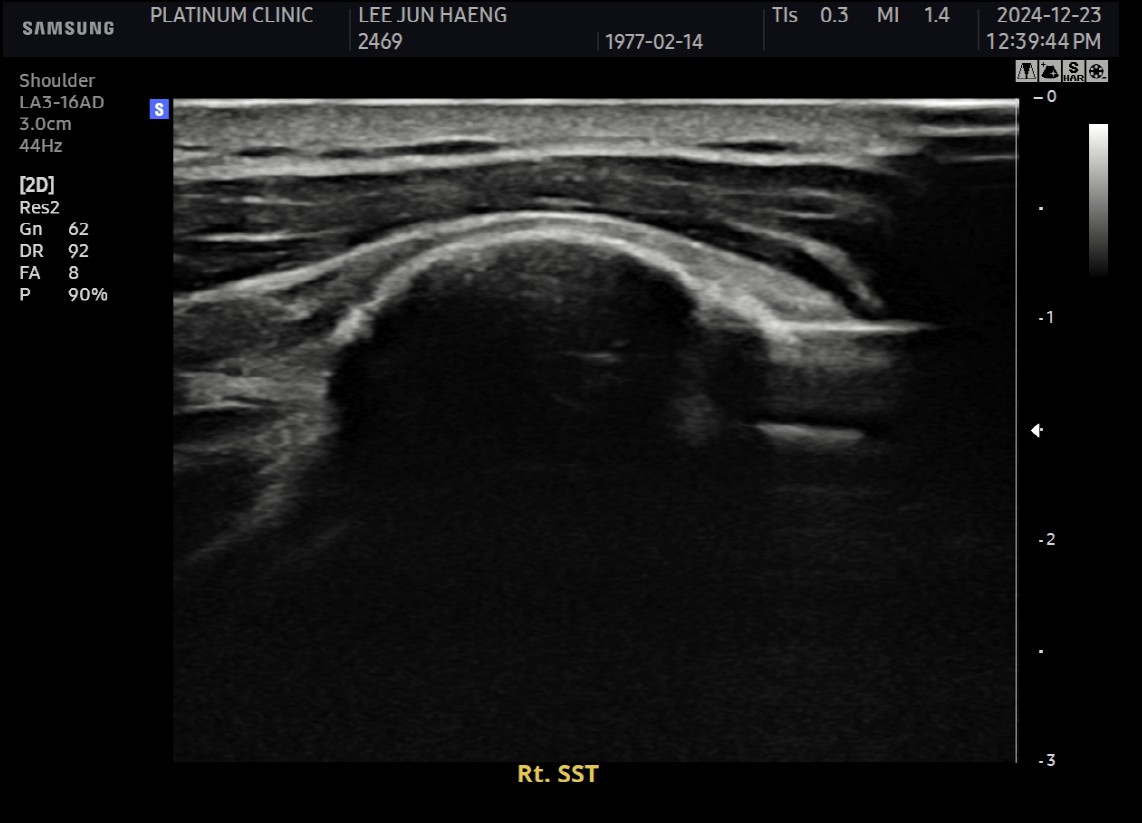 초음파 유도 하 가이드 삽입 모습