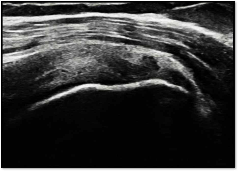 케이스 1: 치료 전 초음파