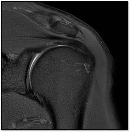 케이스 2: 치료 후 MRI
