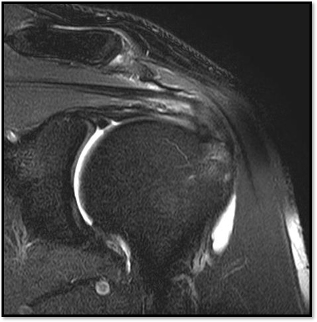 케이스 2: 치료 전 MRI