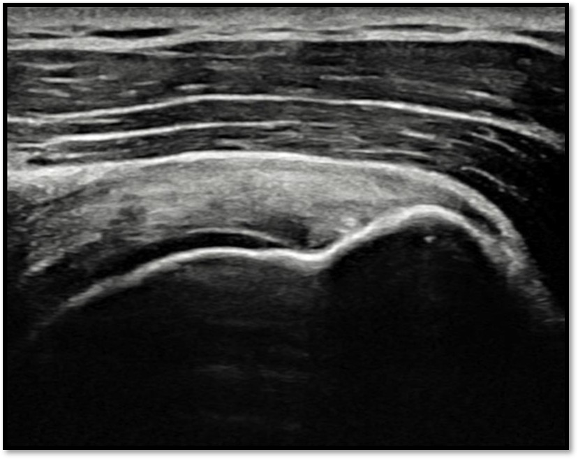 케이스 3: 골수자극 후 재생 과정 2