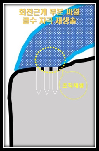 골수자극재생술 모식도 2