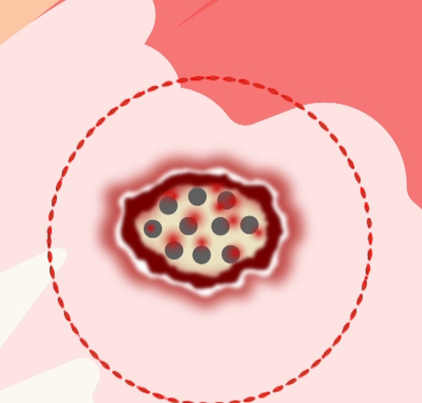 골수자극재생술 원리 모식도