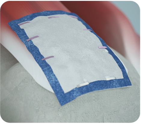 리제네텐 콜라겐 패치 적용 모식도