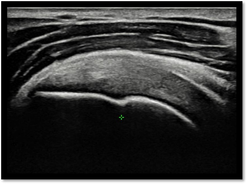케이스 1: 시술 후 초음파