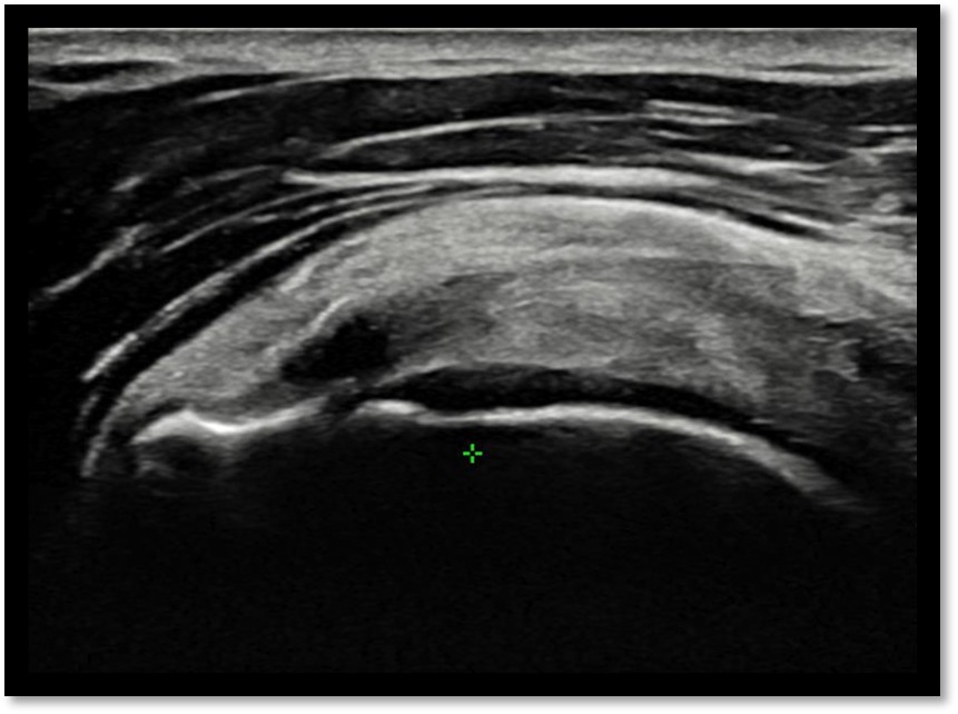 케이스 1: 시술 전 초음파