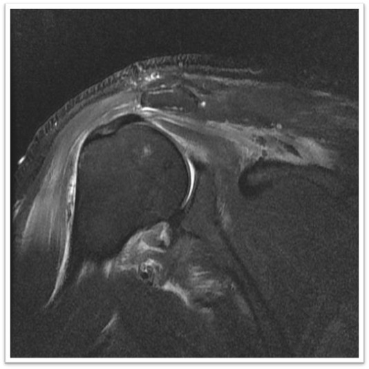케이스 3: 1년 후 MRI