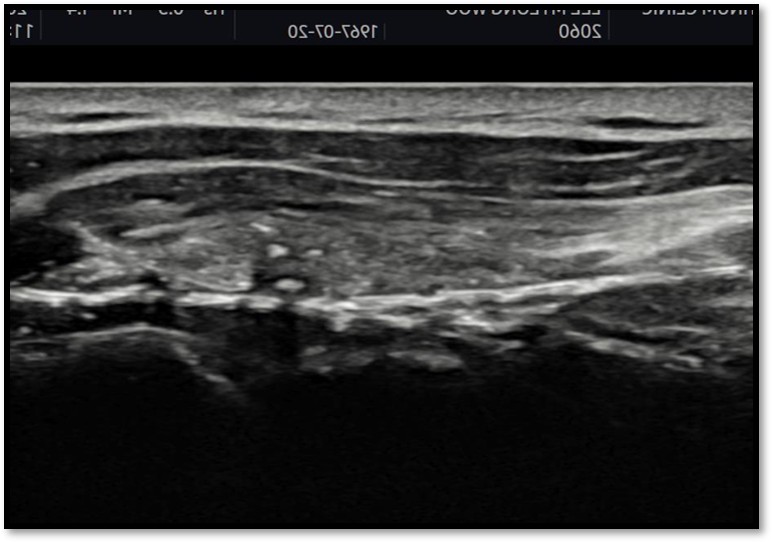 시술 후 초음파 확인